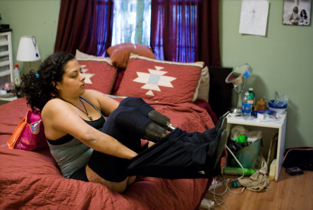Jamie Schanbaum had her legs amputated from the knee down, and part of her fingers.